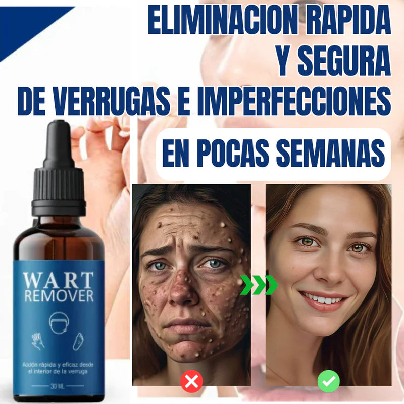 WART REMOVER™ - REMOVEDOR DE IMPERFECCIONES 8 EN 1